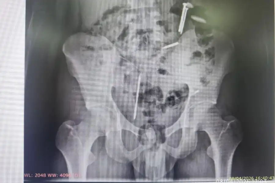 Dua Paku dan Tiga Benda Asing di dalam Tubuh Warga Jember yang Sempat Dipasung Foto BeritaJatim.com