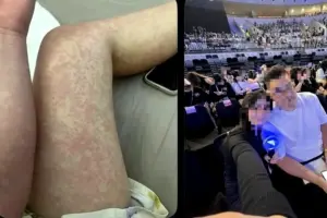 Waspada! Campak Bisa Menular ke 18 Orang Sekaligus, Kenali Gejala dan Bahayanya Foto BeritaJatim.com